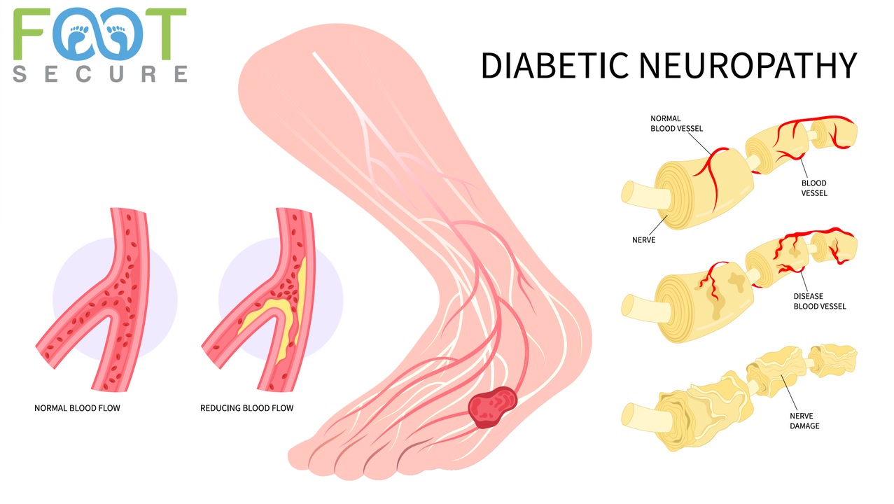 DIABETIC NEUROPATHY